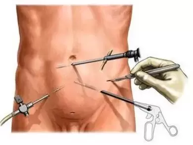 аператыўнае лячэнне хранічнага прастатыту